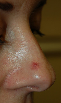 Spider Angioma on nose before treatment